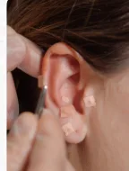 Auriculoterapia