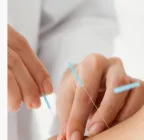 Dry needling